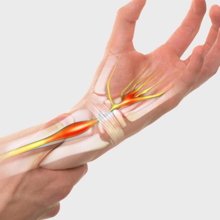 Effective Wrist Pain Treatment in Calgary Divergent Health